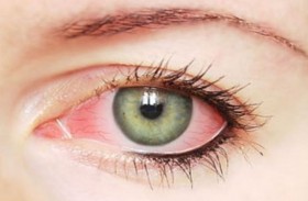 العين الوردية.. أحد الأعراض المقلقة