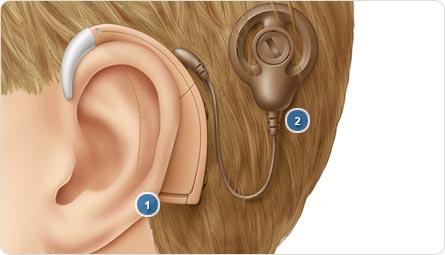 حلول جديدة من الأجهزة السمعية الطبية 