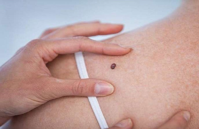 سرطان الجلد.. علماء يسعون للسيطرة على سرطان الخلايا الصبغية العدائي
