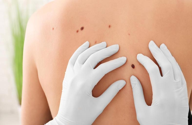 دراسة تكشف قدرة دواء شائع على الوقاية  من بعض أنواع سرطان الجلد