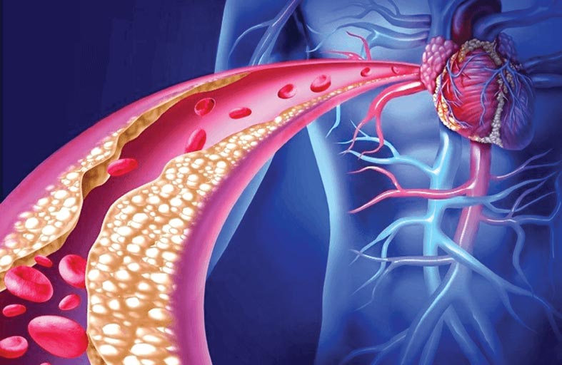 اكتشاف ارتباط بين فرط كوليسترول الدم وعدوانية سرطان المثانة