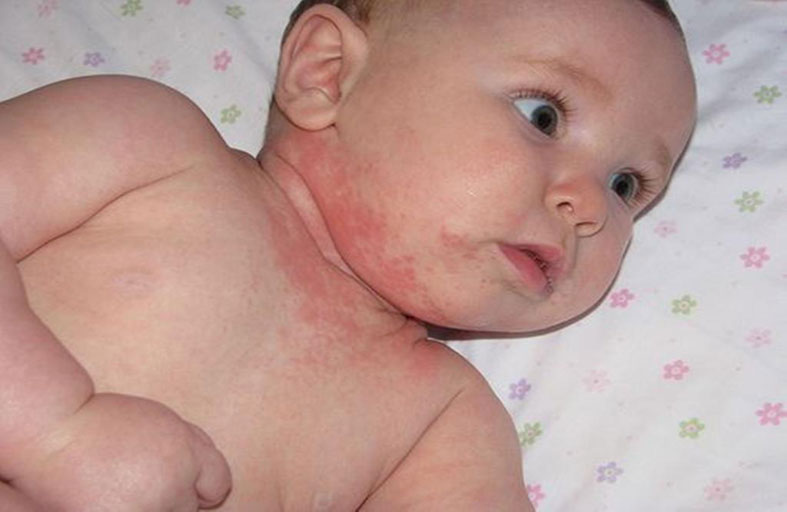 حساسيَّة الجلد لدى الأطفال .. أسبابها وطرق التعامل معها