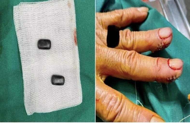يزرع لوحات مغناطيسية في أصابعه للغش