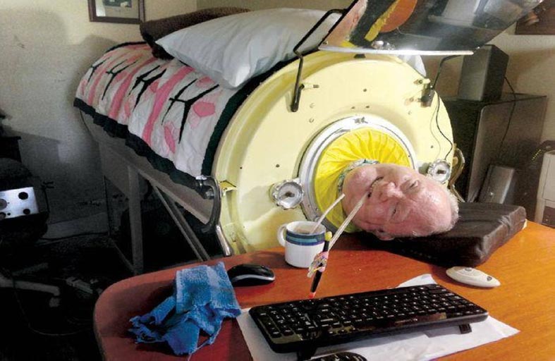 يعيش 70 عاماً داخل جهاز الرئة الحديدية
