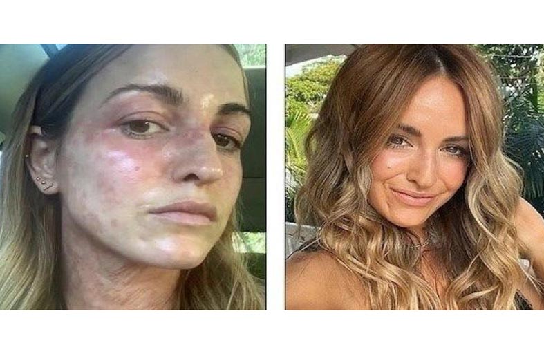 تشفى من الأكزيما بعد عشرين عاماً