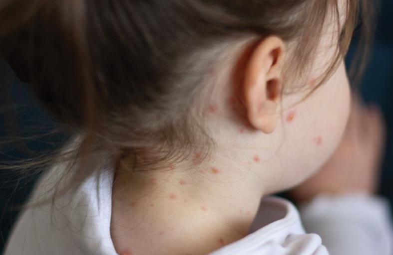 لماذا على الأهل الانتباه إلى الحصبة الألمانية؟