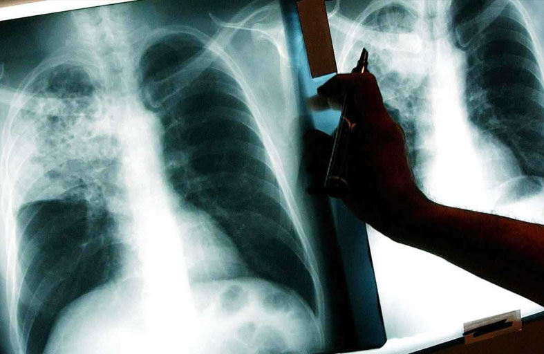 لقاح حديث قد يغيّر مستقبل مكافحة مرض السل