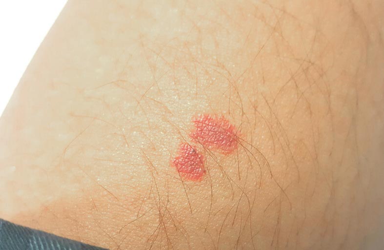 العلامات الحمراء على الجلد.. اعرف الأسباب