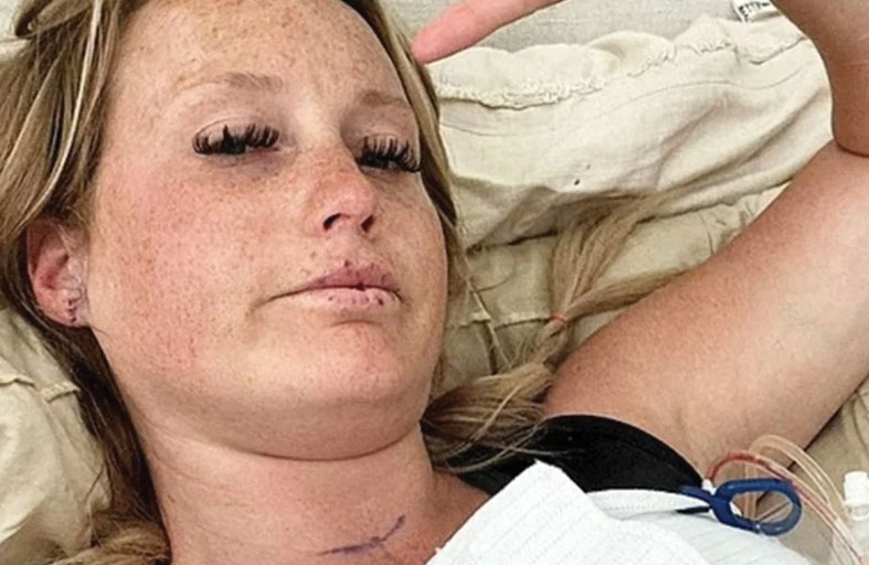 أم تحذر من البوتكس عقب إصابتها بالشلل 