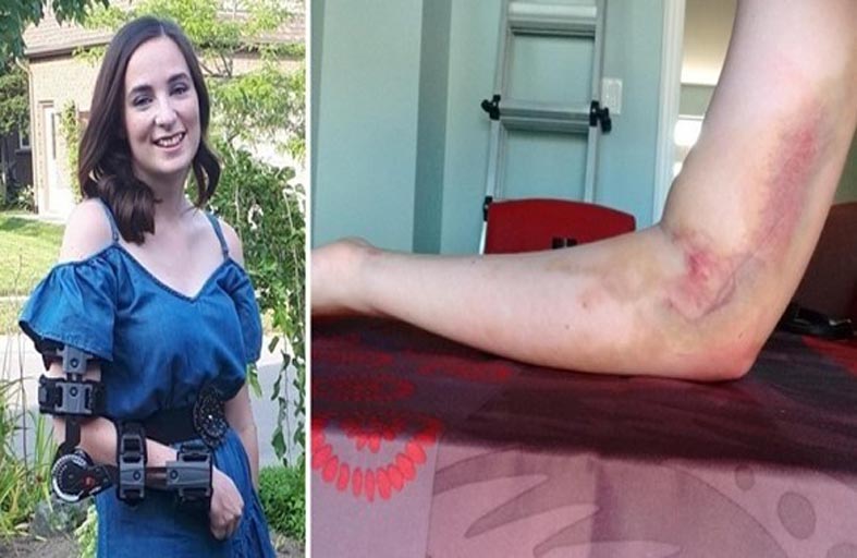 تبرع بالدم يتسبب لها بشلل دائم