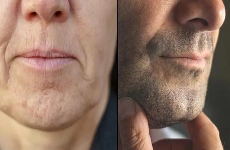 خيبة أمل... بعد معرفة سبب تشكل غمازات الذقن