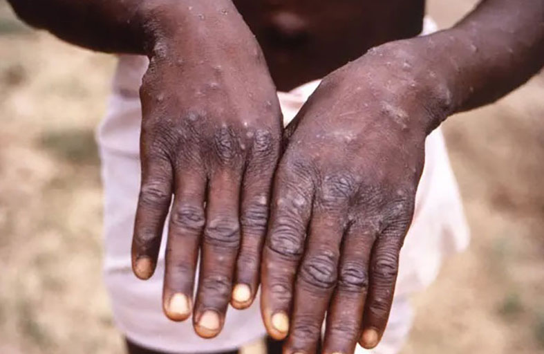 الصحة العالمية تحذر مجدداً من جدري القرود