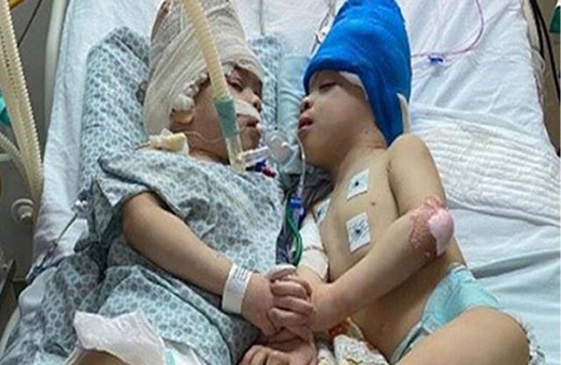 فصل توأمين بتقنية الواقع الافتراضي 