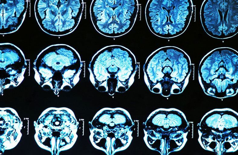 تجربة افتراضية لاختبار علاجين للزهايمر