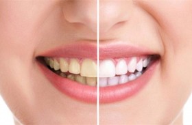 مواد غذائية تغيّر لون الأسنان