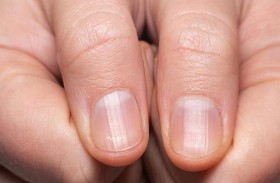الأظافر تكشف إصابتك بالسكري