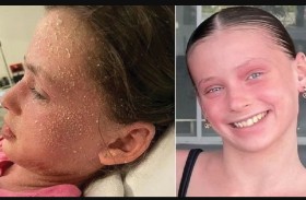 تعاني من حساسية نادرة تجاه دموعها