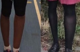 تعاني من حالة نادرة تتسبب بتضخم حجم ساقها 