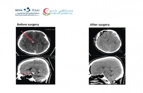 جراحو الأعصاب في مستشفى توام ينجحون في إزالة ورم نزيفي لشاب مواطن  في منطقة الدماغ الأوسط