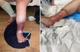 تكاد تفقد ساقيها بلدغة حشرة 