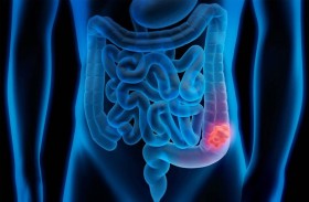 بكتيريا الأمعاء.. فشل التشخيص قد يؤدي إلى السرطان