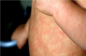 ليفربول..الحصبة تقتل طفلاً   