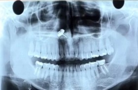 تكتشف وجود قرط عالق في أنفها منذ سنوات