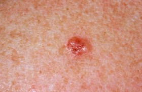 اكتشاف أصغر سرطان جلدي على الإطلاق