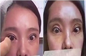 عملية فاشلة تمنعه  من إقفال عينيه 