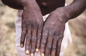 السودان يرصد 5 حالات لجدري القرود
