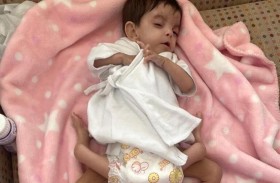 عملية جراحية لفصل توأم طفيلي
