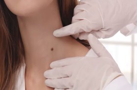 الشامات المريبة.. العلامات التحذيرية وأخطر الأماكن على الجسم