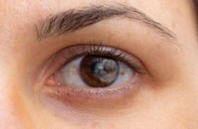 خطورة ظهور بقع أمام العين