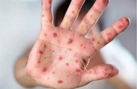 عارض جديد لجدري القرود يهدد القلب