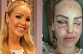 ارتفاع جرائم الأسيد 75 %.. والضحايا أغلبهم نساء