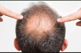 بتقنية ثلاثية الأبعاد.. نحن على بعد خطوة من علاج الصلع