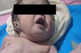 من دون بطن.. تفاصيل ولادة ووفاة طفل بحالة نادرة