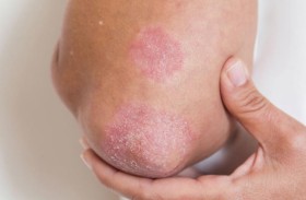 الصدفية.. مرض جلدي بمضاعفات مؤلمة