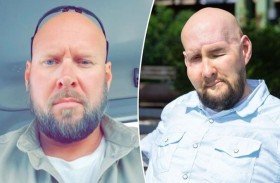 أمريكي يحصل على وجه جديد!