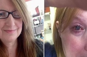 تفقد عينها بعد الاستحمام بالعدسات اللاصقة