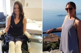 آلام بسيطة في الفك تنتهي ببتر يدي وقدمي فتاة