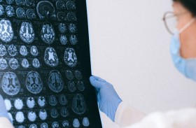 السكتة الدماغية.. كم كوبا من الماء تحتاج لتقليل المخاطر؟