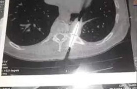 خنجر عالق بظهر رجل منذ 25 عاماً