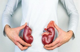 كيف يؤدي فشل الكلى المزمن إلى زيادة خطر الإصابة بأمراض القلب؟