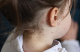 لماذا على الأهل الانتباه إلى الحصبة الألمانية؟