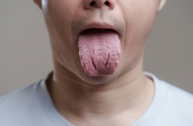 إلى ماذا تشير تشققات اللسان؟