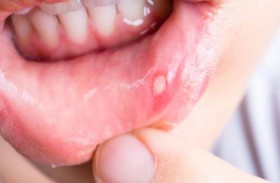 «نوما» آكلة الفم.. المرض الخطير المهمل!