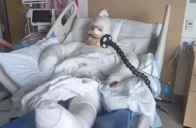 أم تُصاب بحروق خطيرة بعد هجوم بقنبلة حارقة على سيارتها