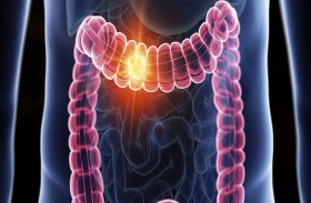 لون البراز قد يكون «علامة مبكرة» دالة على سرطان الأمعاء!