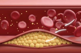 تغييرات فعّالة لخفض الكوليسترول